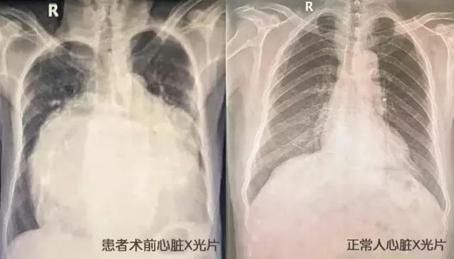 最新机械瓣膜技术革新与应用前景展望