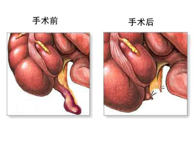 数字化时代下的阑尾手术下载，医疗技术与资源获取的新篇章