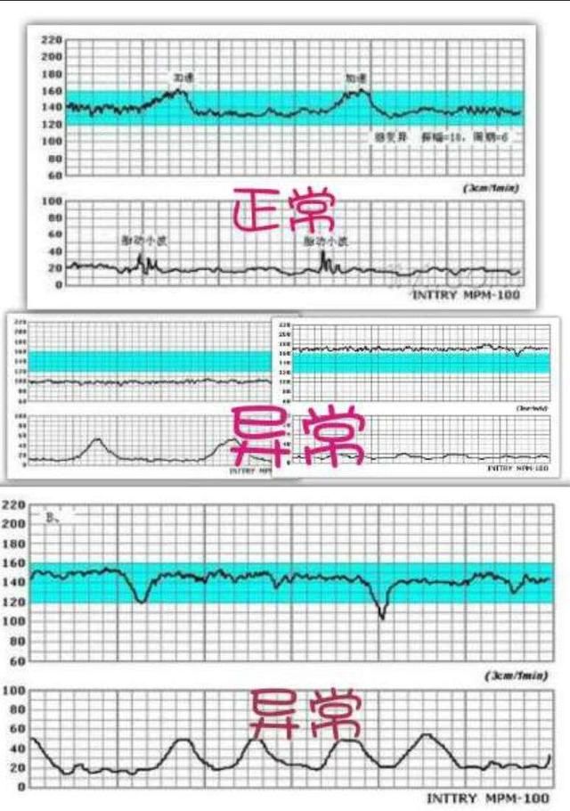 胎心监测软件，守护母婴健康的必备神器